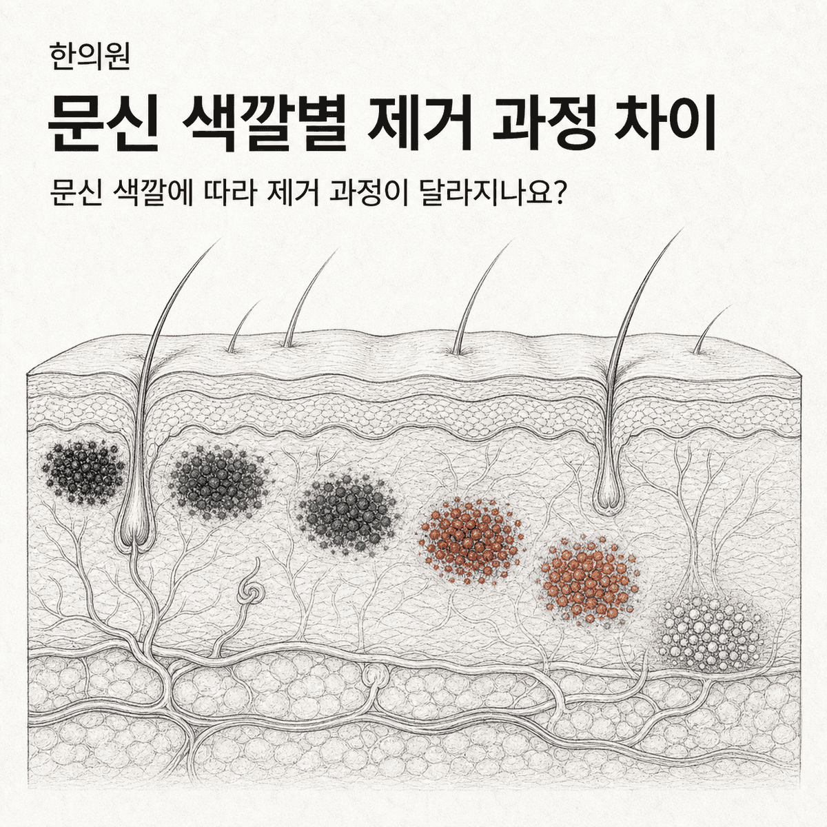 광주 한의원 문신 색깔별 제거 과정 차이 핵심 정보 이미지