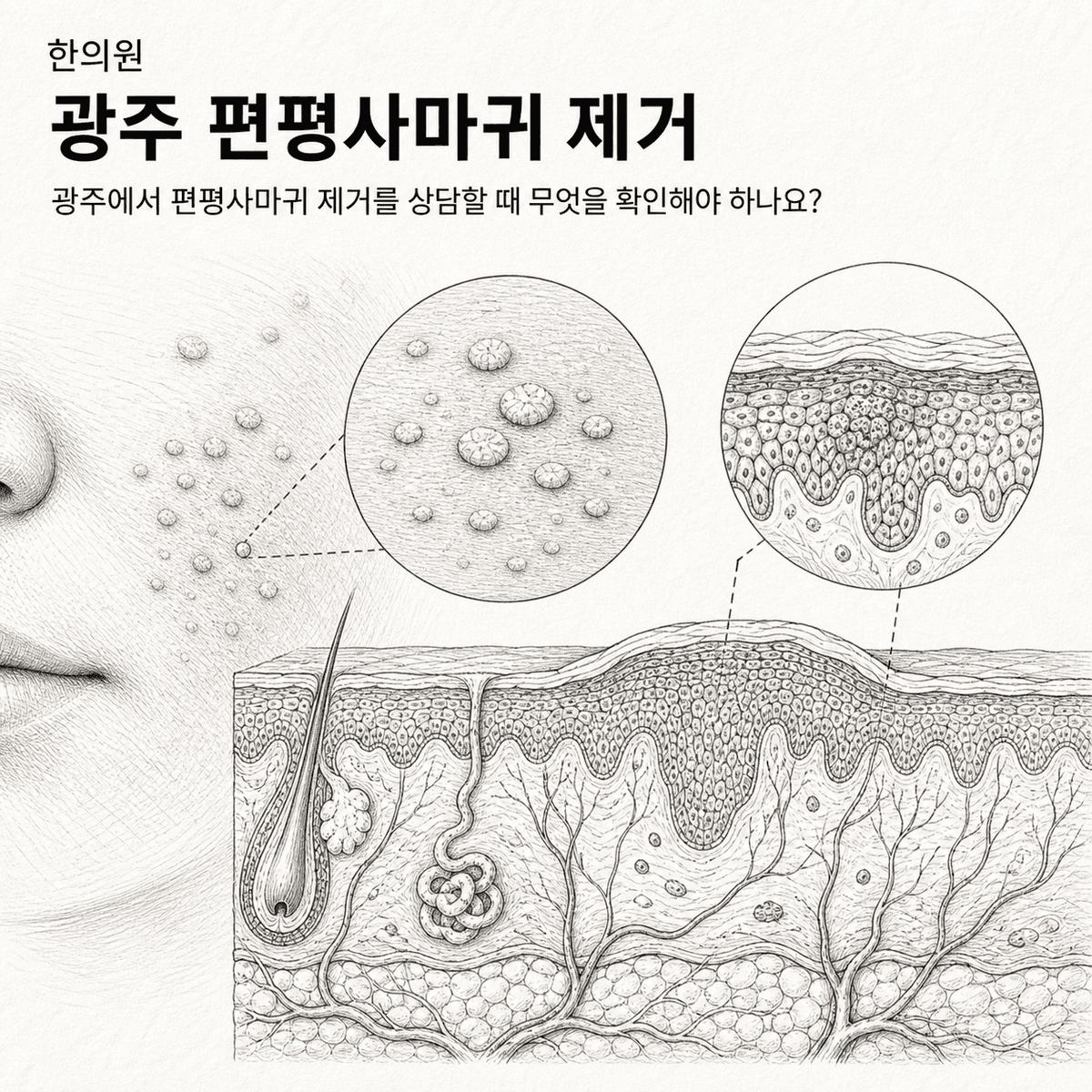 광주 한의원 편평사마귀 제거 핵심 정보 이미지