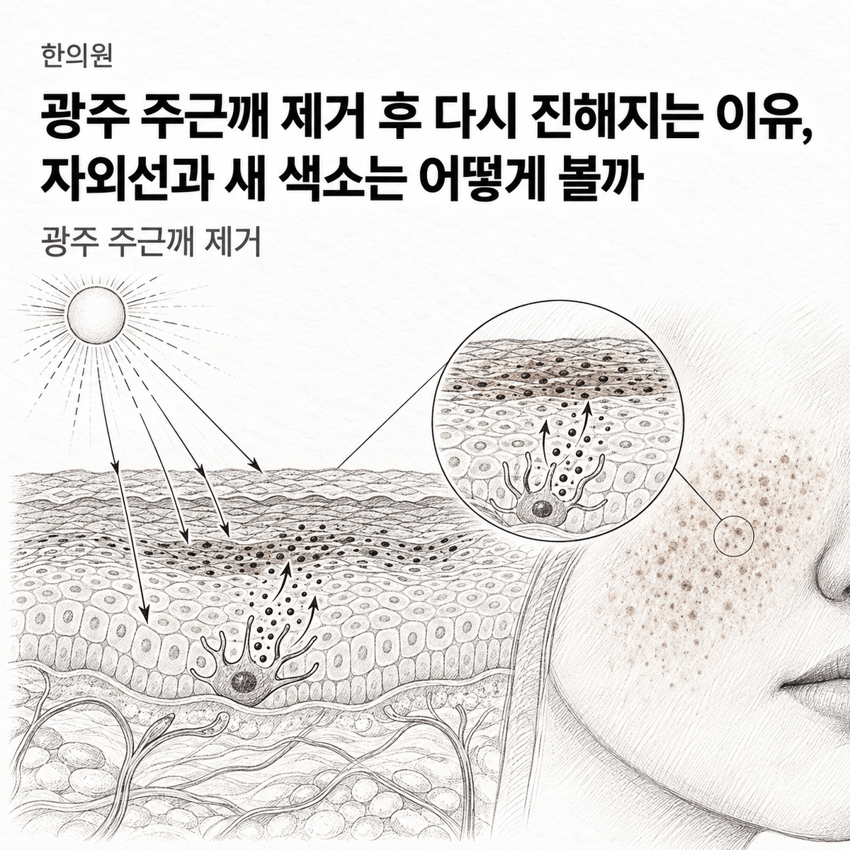 광주 한의원 주근깨 제거 후 다시 진해지는 이유, 자외선과 새 색소는 어떻게 볼까 핵심 정보 이미지