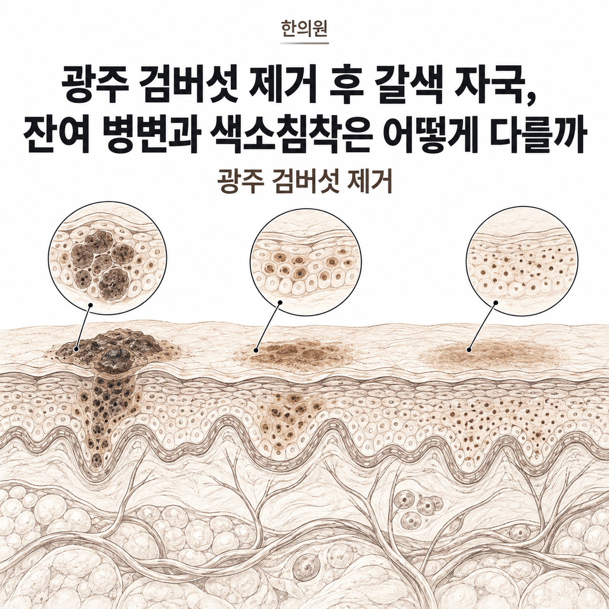 광주 한의원 검버섯 제거 후 갈색 자국, 잔여 병변과 색소침착은 어떻게 다를까 핵심 정보 이미지