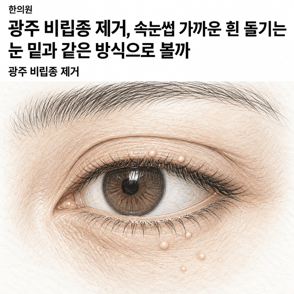 광주 한의원 비립종 제거, 속눈썹 가까운 흰 돌기는 눈 밑과 같은 방식으로 볼까 핵심 정보 이미지