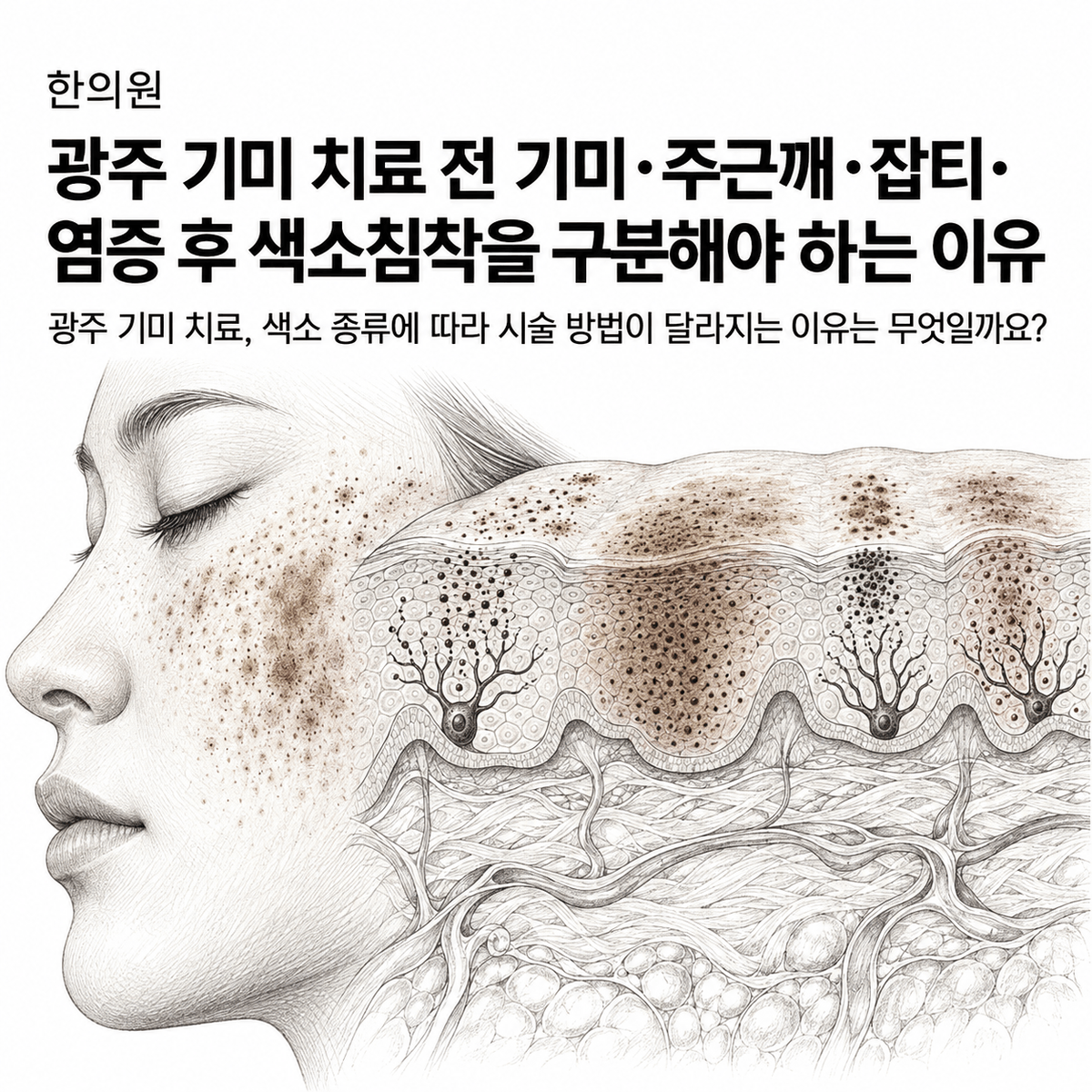 광주 한의원 기미 치료 전 기미·주근깨·잡티·염증 후 색소침착을 구분해야 하는 이유 핵심 정보 이미지