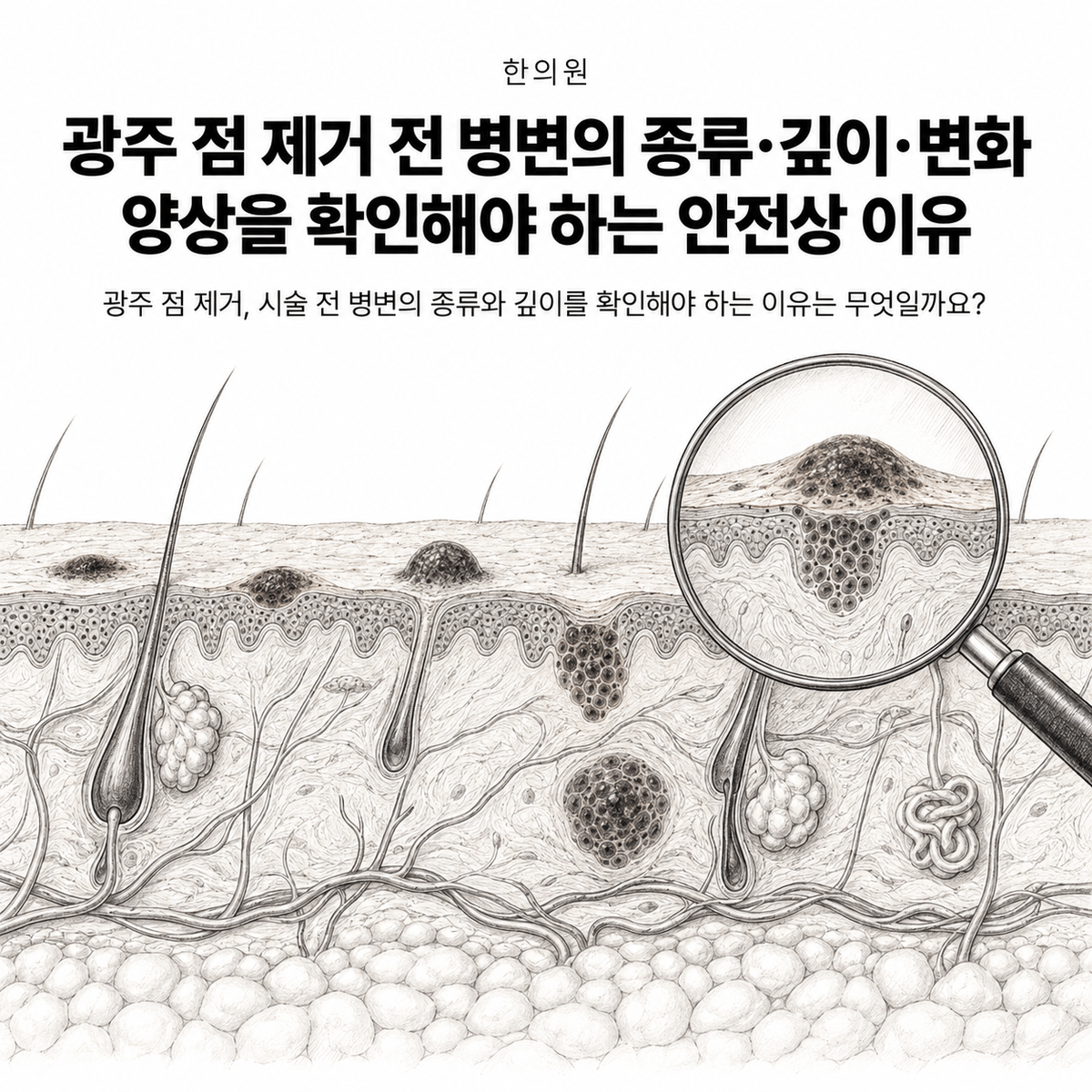 광주 한의원 점 제거 전 병변의 종류·깊이·변화 양상을 확인해야 하는 안전상 이유 핵심 정보 이미지