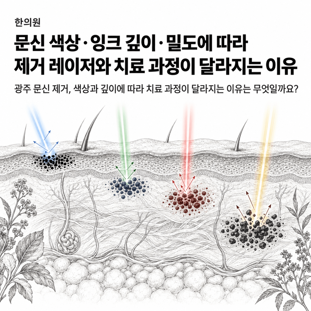 광주 한의원 문신 색상·잉크 깊이·밀도에 따라 제거 레이저와 치료 과정이 달라지는 이유 핵심 정보 이미지